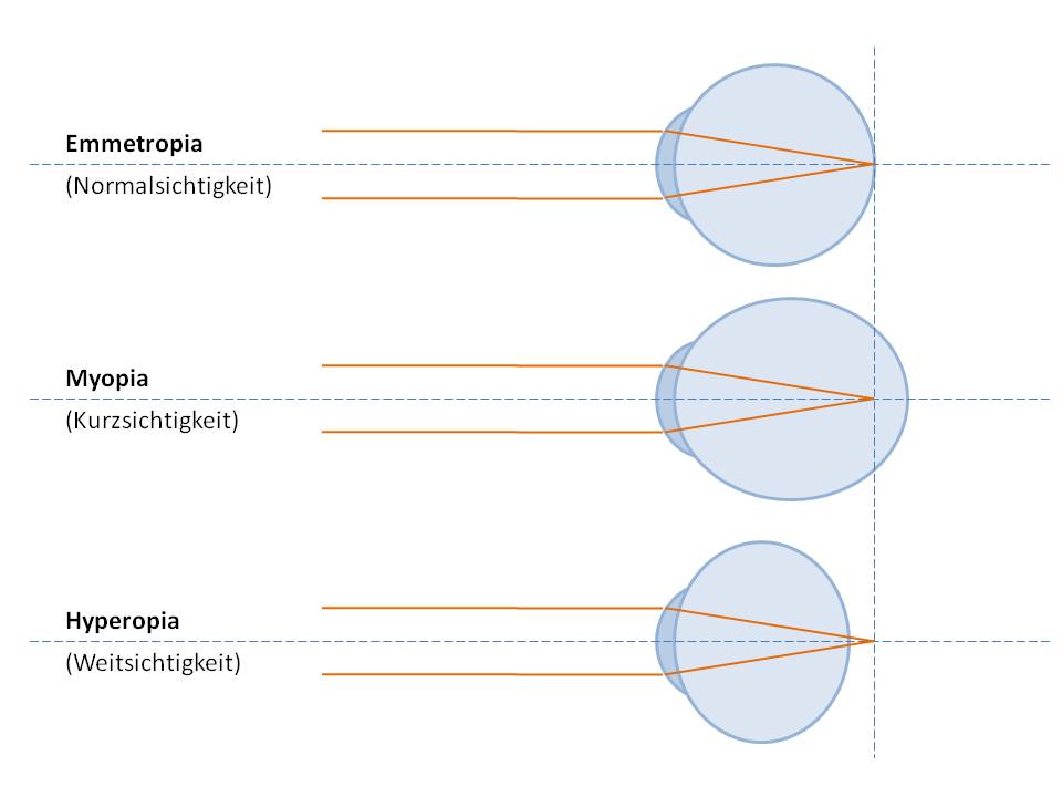 optik inspektor kurzsichtig weitsichtig myop hyperop