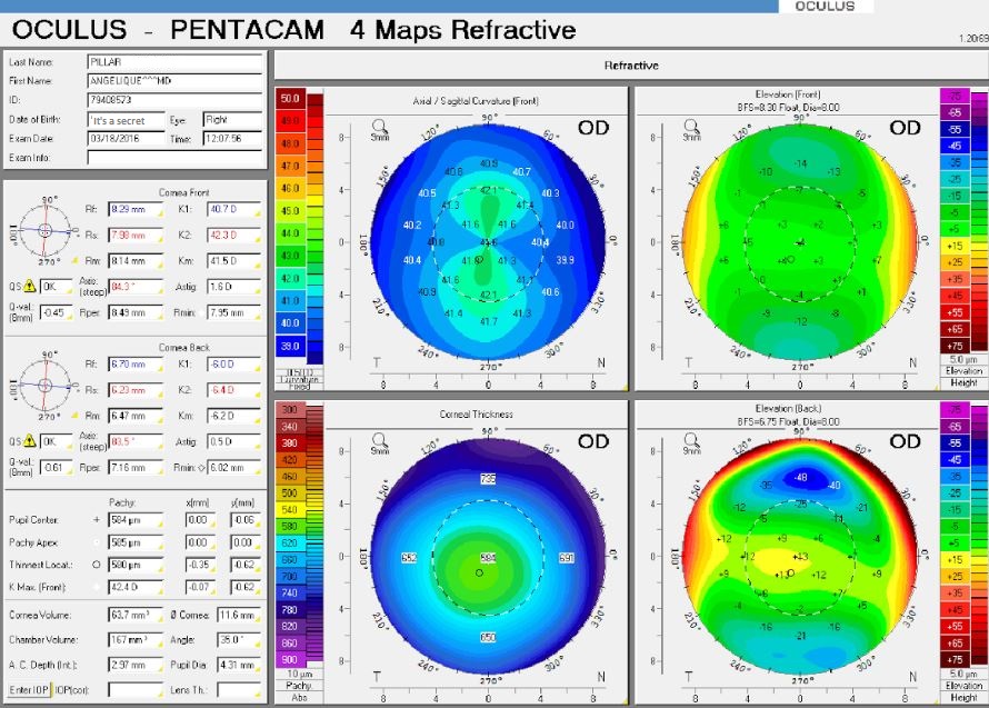 der optik inspektor refractive surgery 